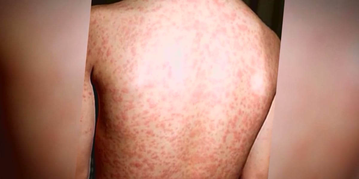 Sedgwick County confirms first measles case, alerts public to location of possible exposure - KWCH